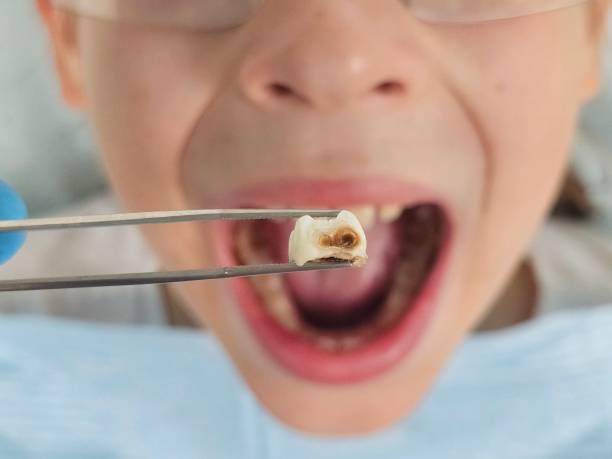 Best Emergency Wisdom Tooth Extraction in Braddock Hills, PA